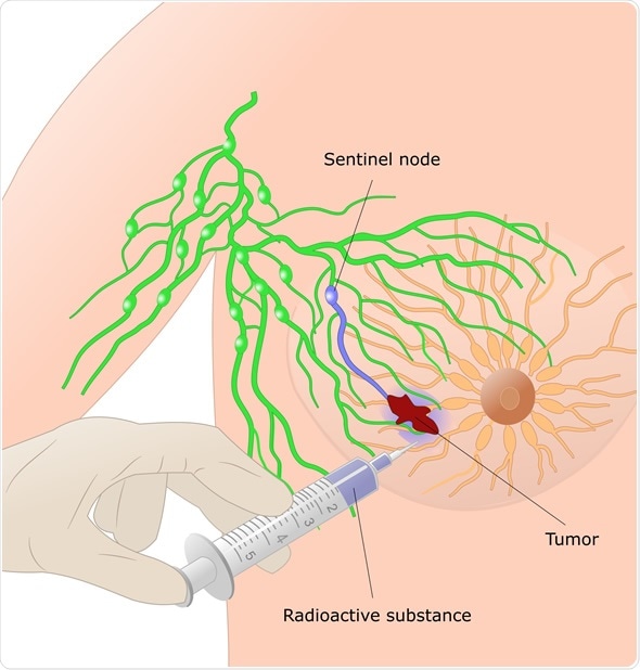 Breast cancer: finding the sentinel node before surgery - Image ID Copyright: ellepigrafica / Shutterstock